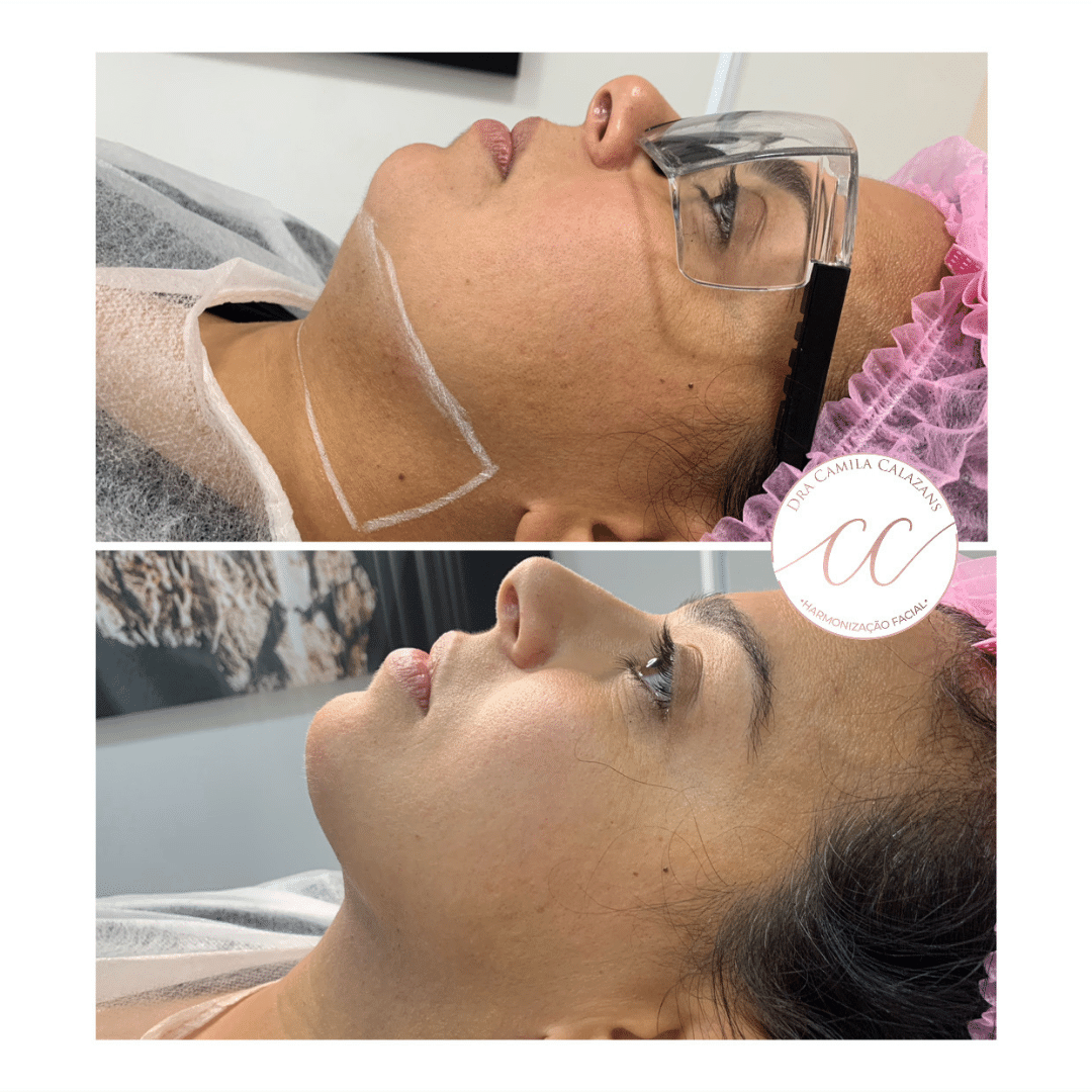 Harmonização Facial - Dra. Camila Calazans