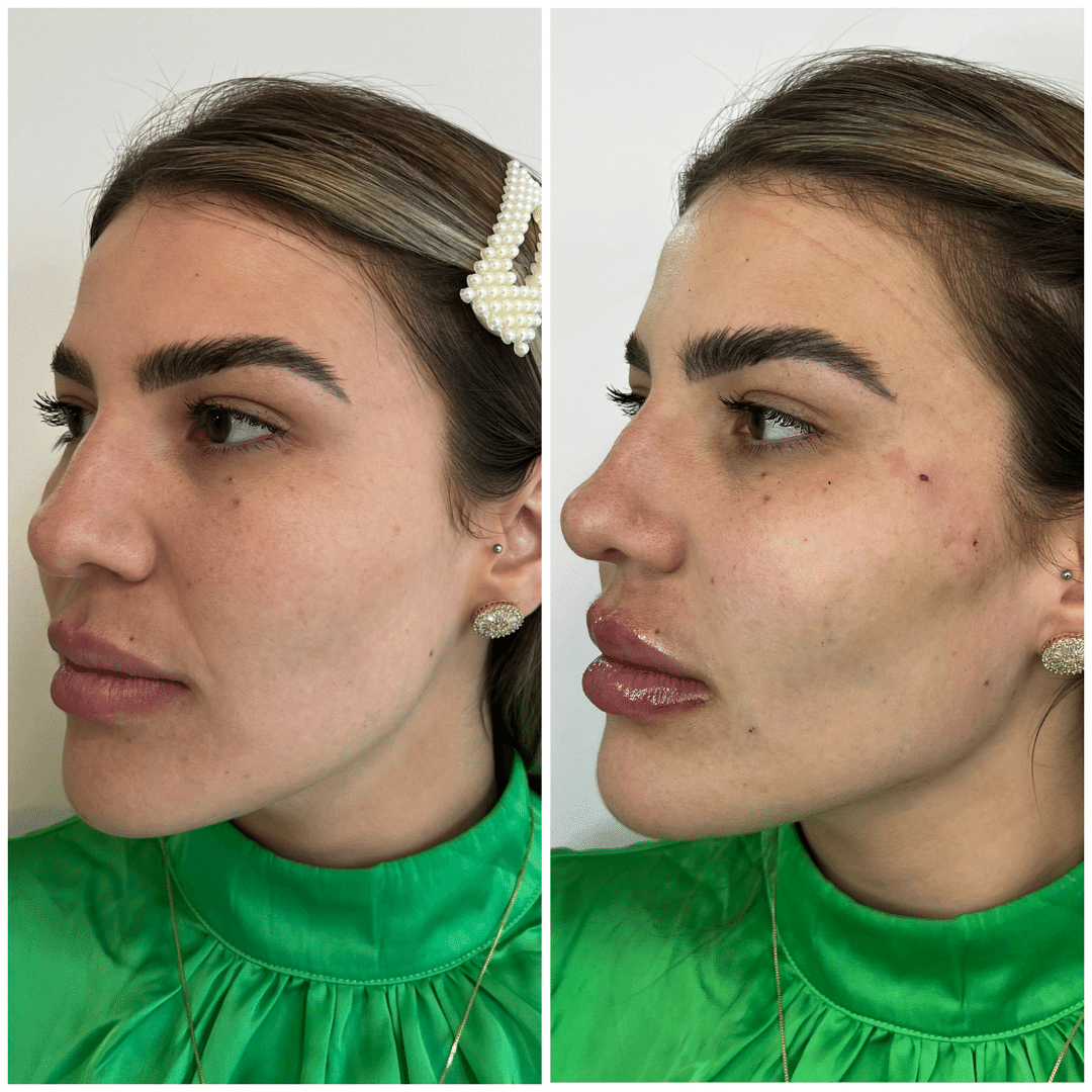 Harmonização Facial - Dra. Camila Calazans