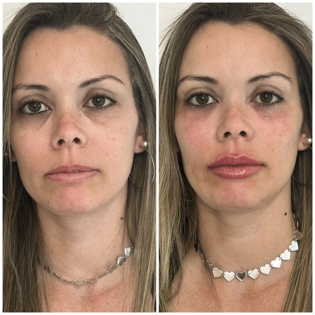 Harmonização Facial - Dra. Camila Calazans