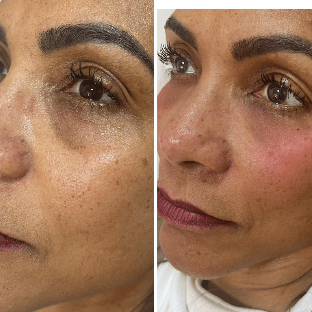 Harmonização Facial - Dra. Camila Calazans