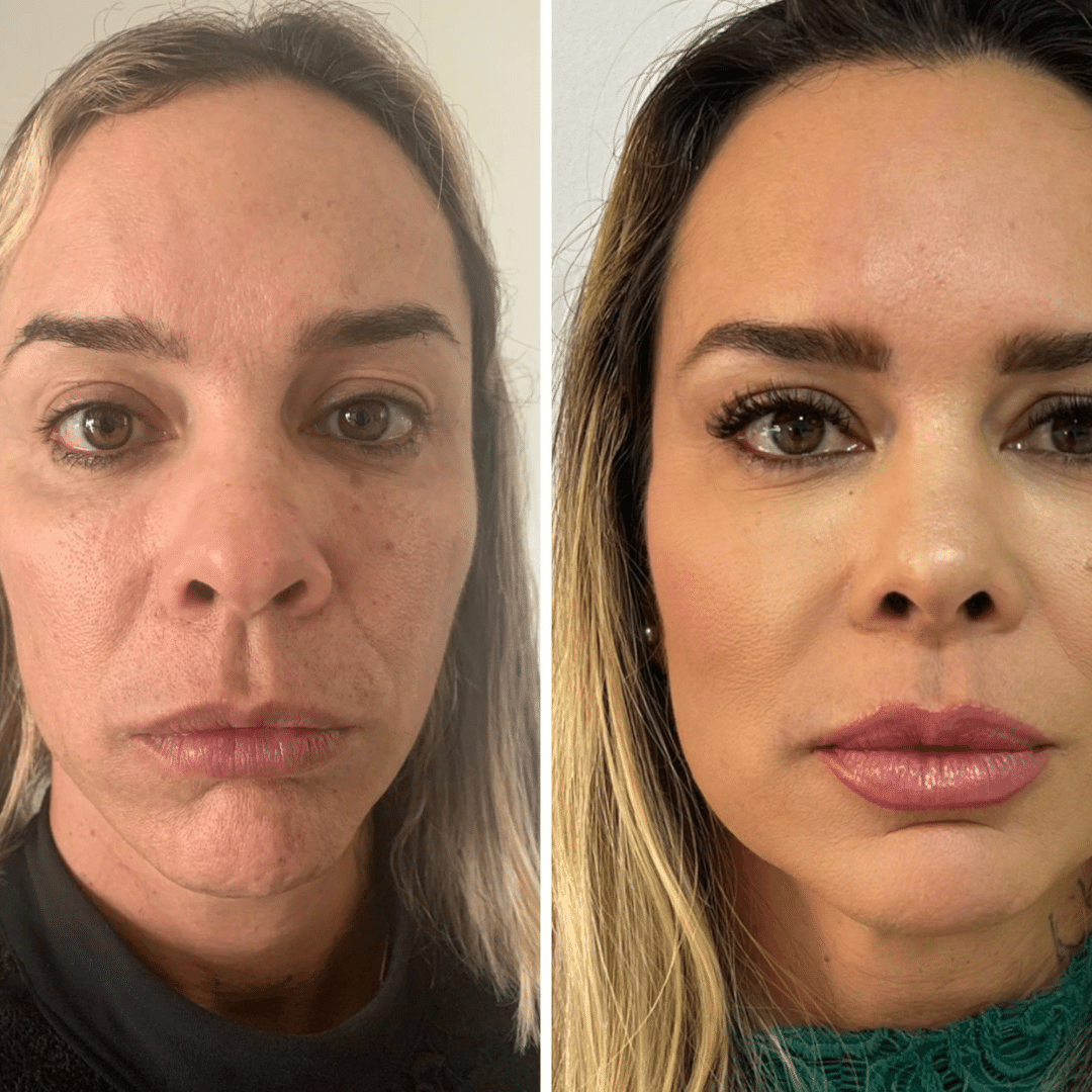 Harmonização Facial - Dra. Camila Calazans