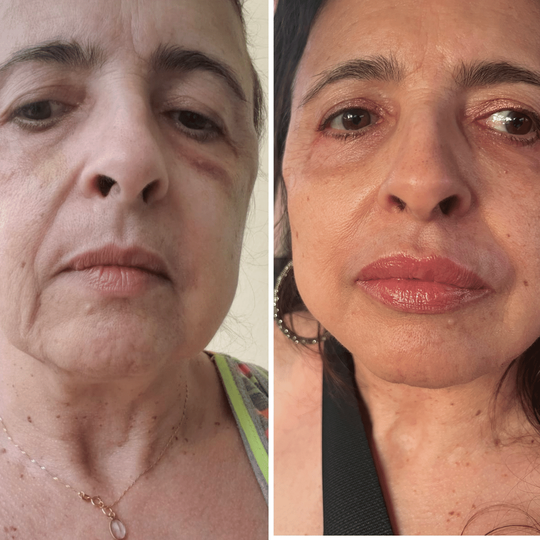 Rejuvenescimento Facial 4