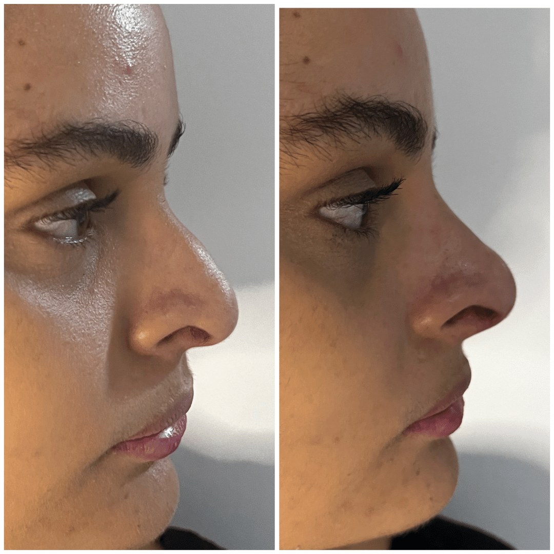 Harmonização Facial - Dra. Camila Calazans