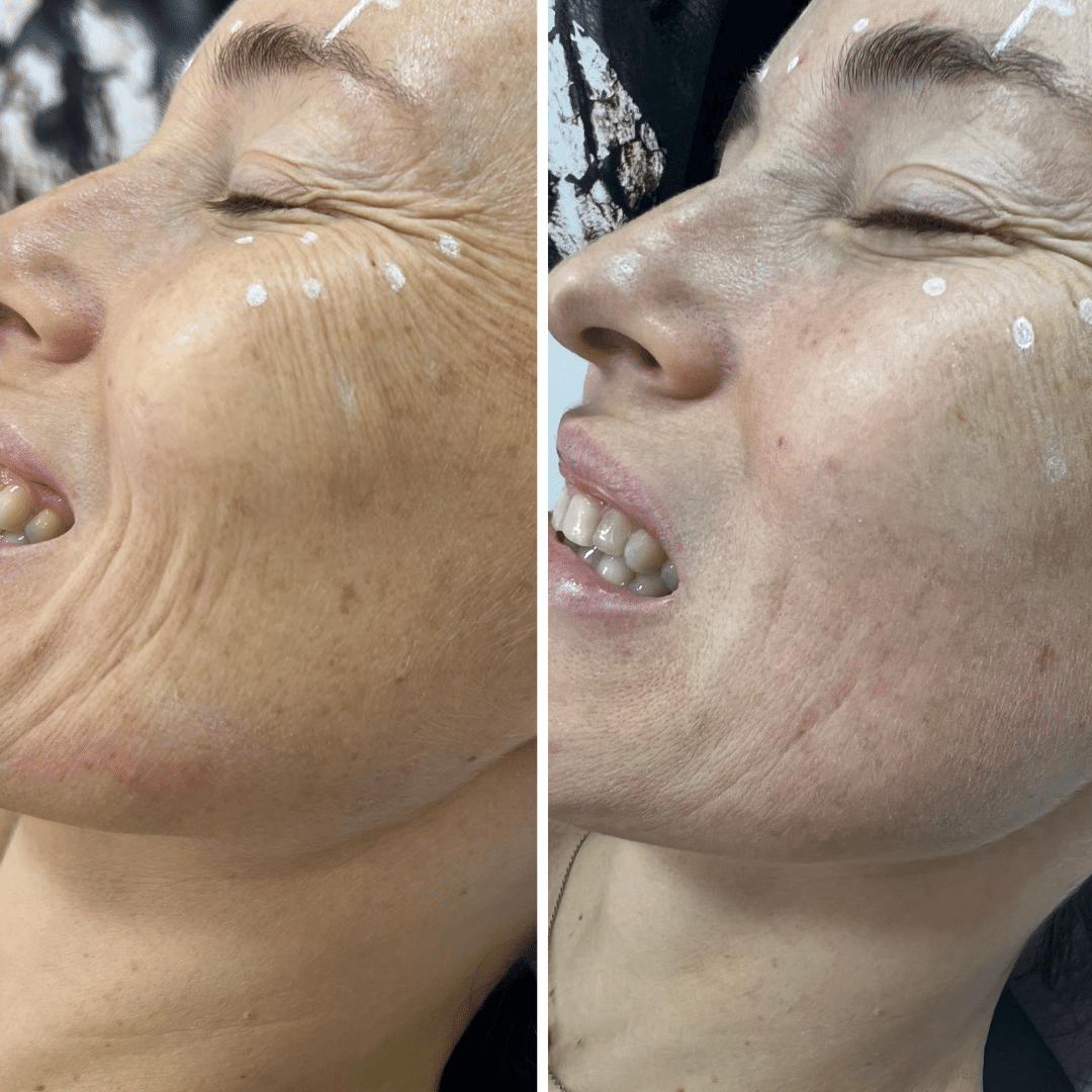 Harmonização Facial - Dra. Camila Calazans